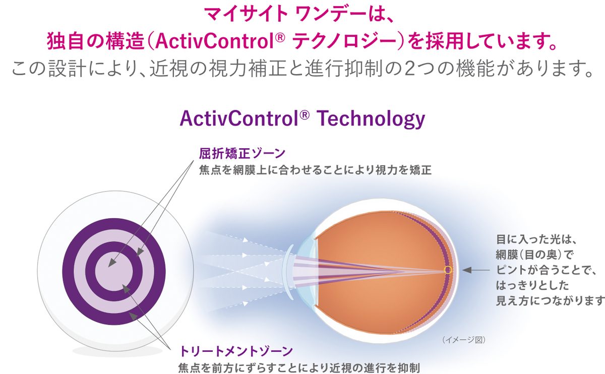 ActivControlテクノロジーの図：屈折矯正ゾーンで視力を矯正し、トリートメントゾーンで焦点を前方にずらして近視の進行を抑える仕組み